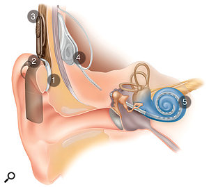 Implanting Awareness